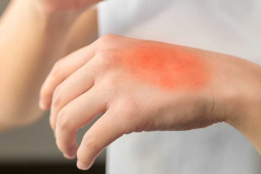 All you need to know about ice burn and its treatment