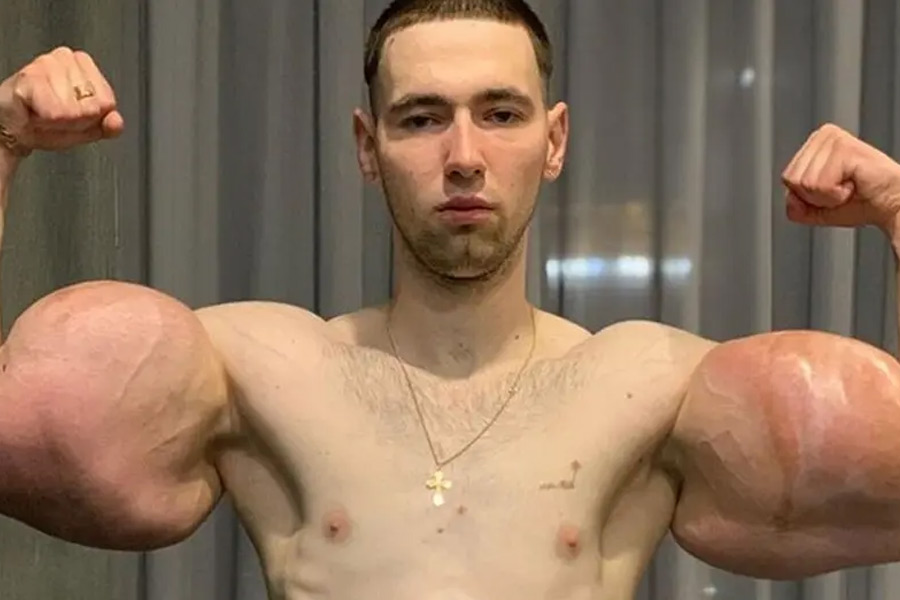 হাতের পেশি স্ফীত করতে অদ্ভুত এক পন্থা নিয়েছিলেন কিরিল। তার ফল যে এ ভাবে ভুগতে হবে, ভাবতেও পারেননি। প্রাণ যেতে বসেছিল যুবকের। এখন আফসোস হয় নিত্য দিন।