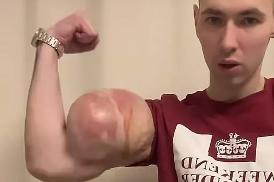 পেশির ‘শক্তি’ বৃদ্ধি করতে ইঞ্জেকশনের মাধ্যমে হাতে পেট্রোলিয়াম জেলি প্রবেশ করিয়েছিলেন তিনি। অবিমৃশ্যকারিতার ভয়ঙ্কর ফল ভুগতে হয়েছিল তাঁকে। একাধিক পার্শ্বপ্রতিক্রিয়া দেখা গিয়েছিল তাঁর শরীরে।