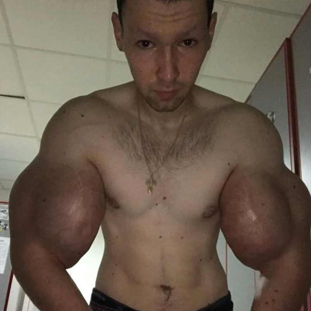 হাতে তিন লিটার পেট্রোলিয়াম জেলি ইঞ্জেকশনের মাধ্যমে প্রবেশ করিয়েছিলেন কিরিল। সরাসরি। এর ফলে তাঁর পেশিতে রক্তের সরবরাহ বন্ধ হয়ে যায়। পেশির কিছু কলা পুরোপুরি নষ্ট হয়ে যায়।