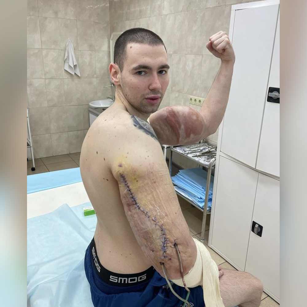 ওই বিপুল পরিমাণ জেলি অপসারণ করা না হলে কিরিলের হাত কেটে বাদ দিতে হত চিকিৎসকদের। যদিও সেই জেলি বার করার পরেও সমস্যা পুরোপুরি নির্মূল হয়নি।