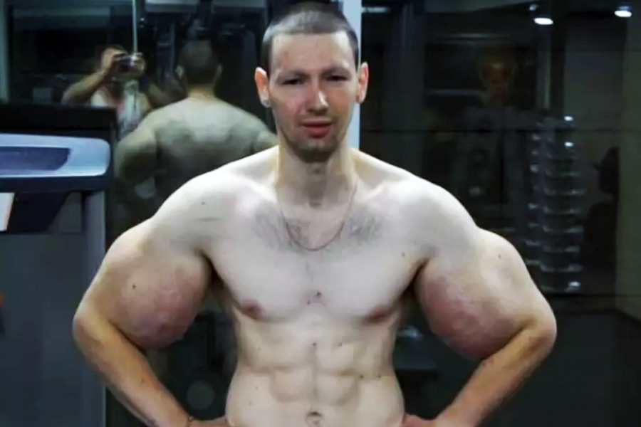 গত কয়েক বছর ধরে একের পর এক অস্ত্রোপচার হয় তাঁর হাতে। পেট্রোলিয়াম জেলির পাশাপাশি মৃত কলাও বার করা হয়। কিরিল জানিয়েছেন, দিনগুলি তাঁর কাছে ছিল ‘দুঃস্বপ্নের মতো’।