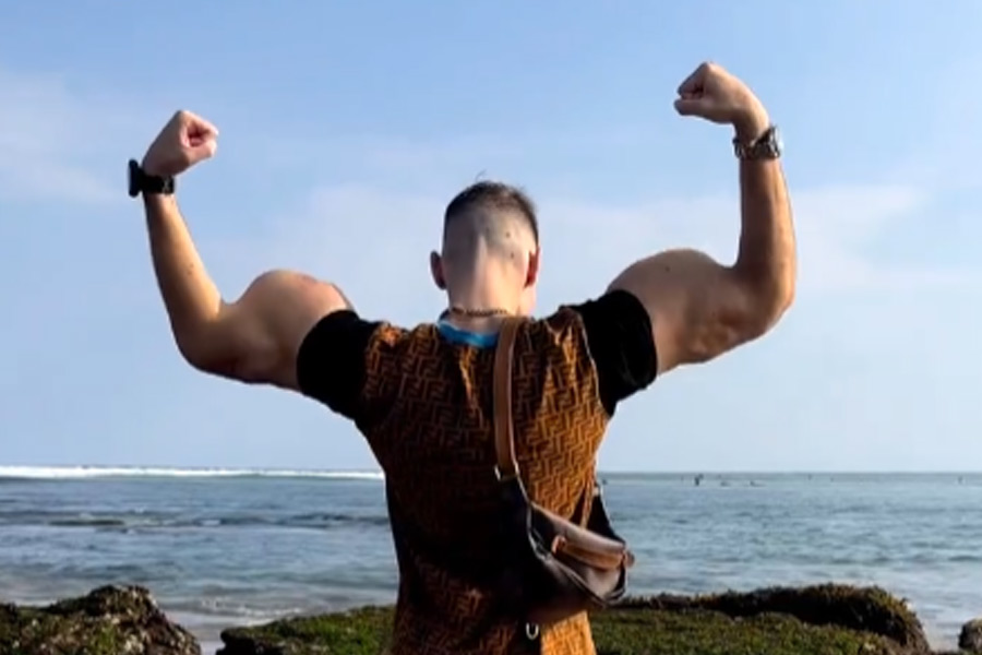 বছরের পর বছর চিকিৎসা করেও কিরিলের বাইসেপের খুব একটা সঙ্কোচন হয়নি। এখনও অস্বাভাবিক রকমের স্ফীত সেগুলি। সম্প্রতি কিরিল সমাজমাধ্যমে লিখেছেন, ‘‘এই হাত দুটো থেকে মুক্তি পেতে চাই।’’