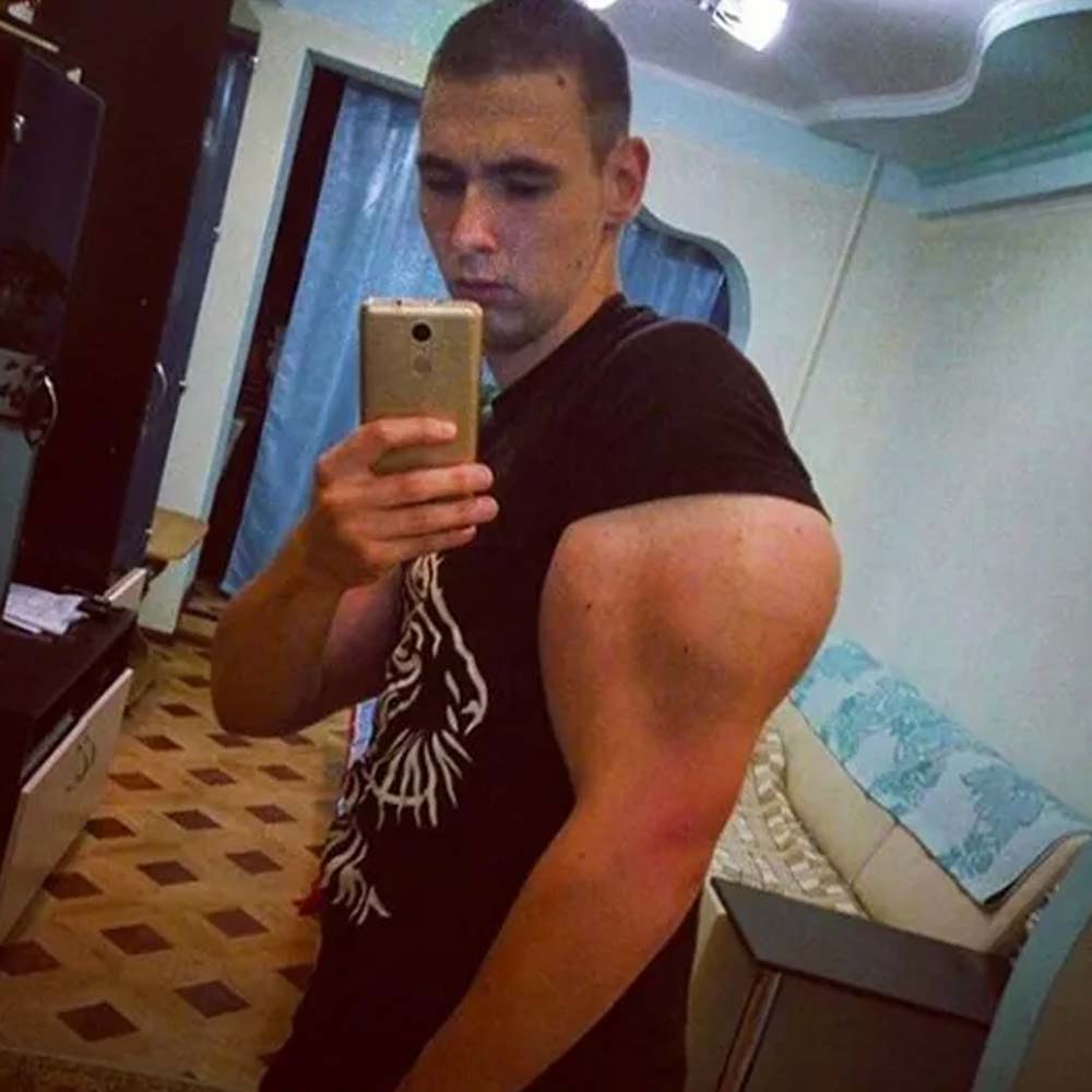 হাতের পর মুখেও কারিকুরির অন্ত রাখেননি কিরিল। স্ফীত বাইসেপের পাশাপাশি নিজের মুখকেও আকর্ষণীয় করে তুলতে চেয়েছিলেন তিনি। কিরিলের মুখেও একাধিক অস্ত্রোপচার করা হয়েছে। ৪০ মিলিলিটার ‘ফিলার’ ইঞ্জেকশনের মাধ্যমে প্রবেশ করানো হয়েছে, যাতে মুখ ভরাট দেখায়।