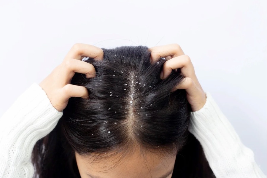 Should you apply glycerine to your scalp