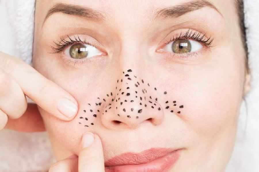 Home remedies for Blackheads problem