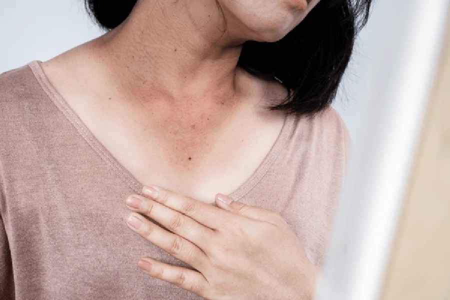 Natural Remedies to remove Neck Dark Patches