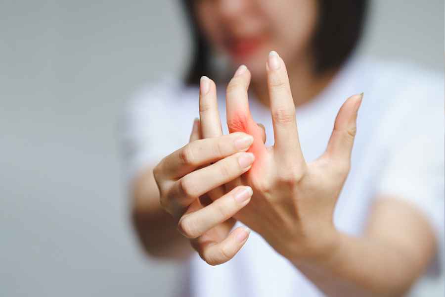 Five early signs of rheumatoid arthritis
