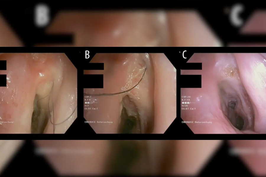52-year-old man grows rare hair in throat after years of heavy smoking