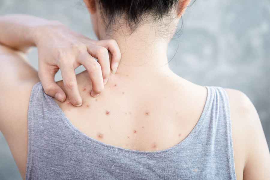 Five tips to treat back acne at home