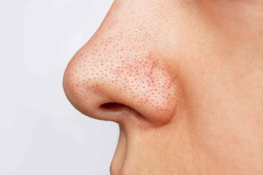 Five beauty benefits of alum or fitkari