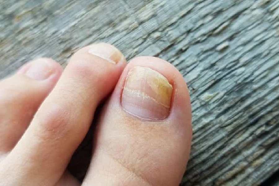 Warning signs of high cholesterol in your nails you should take note of