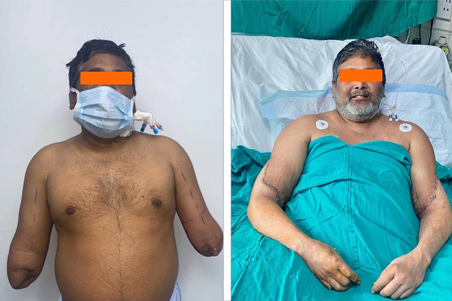 Delhi man gets hands back as organ donation meets surgical excellence