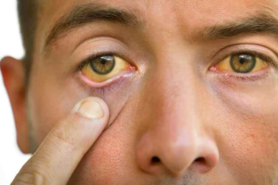 Warning signs of high cholesterol in your eyes that you should not ignore