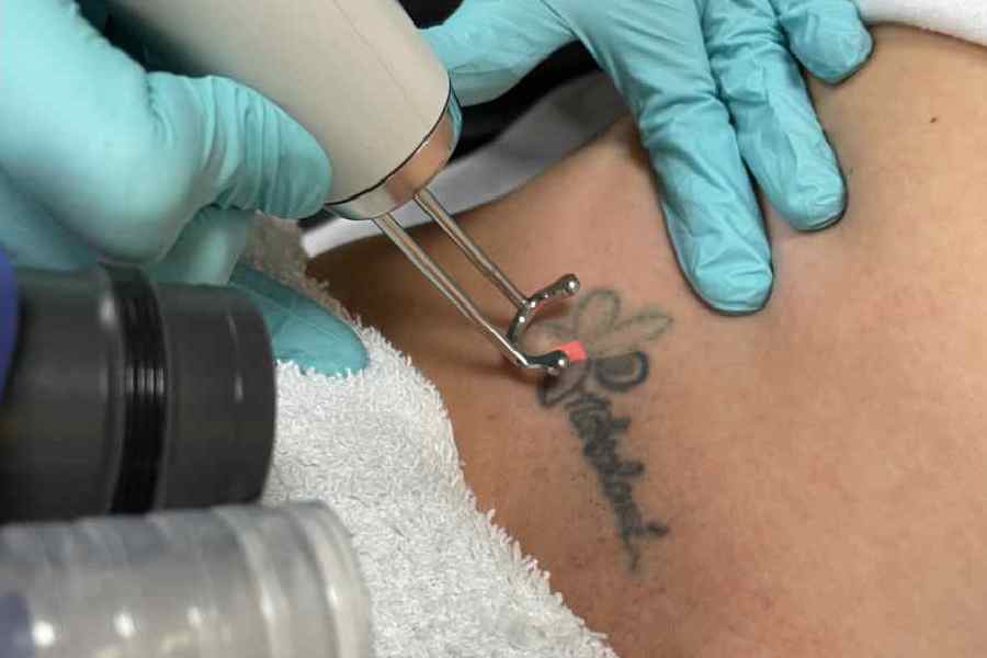 How to choose tattoo removal service
