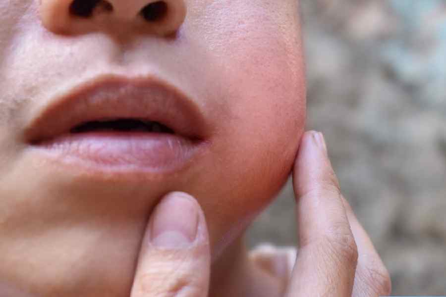 All you need to know about Mumps Symptoms and prevention