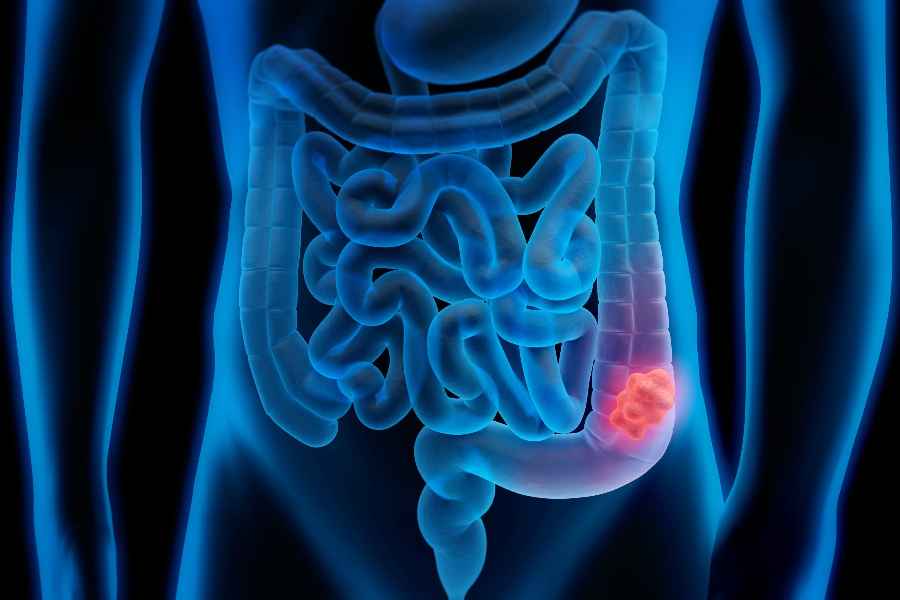 Colon cancer symptoms and prevention tips 