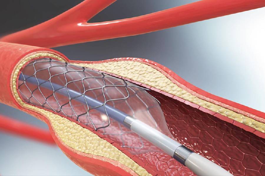 When to consider leg surgery in angioplasty 