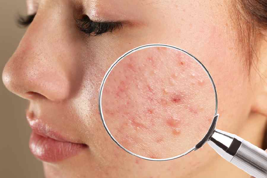 Avoid these sleeping mistakes that can trigger acne problem