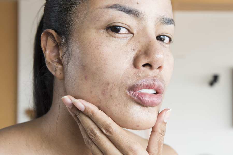 How to care for your oily and acne prone skin this summer