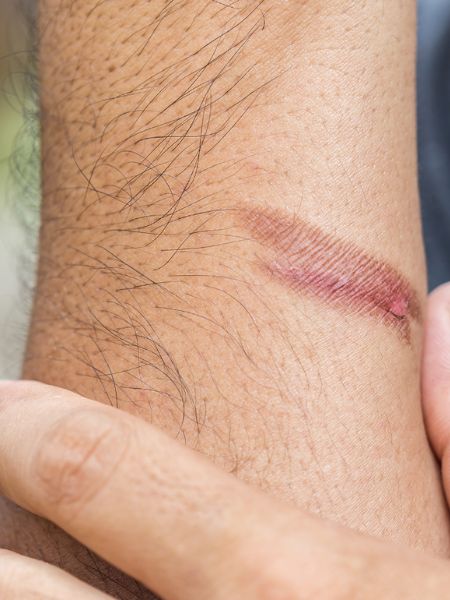 follow these home remedies to remove burn marks from skin dgtl