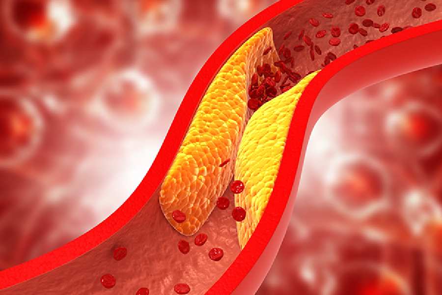 Symptoms of high cholesterol that shouldn’t be ignored