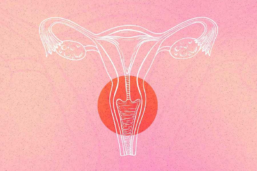 Causes of irregular periods can lead to cervical cancer