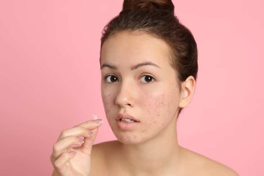 Foods to avoid eating to prevent summer acne
