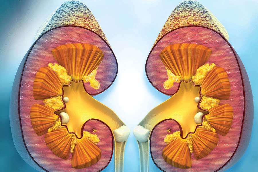 First Person to receive Pig kidney transplant dies after two month