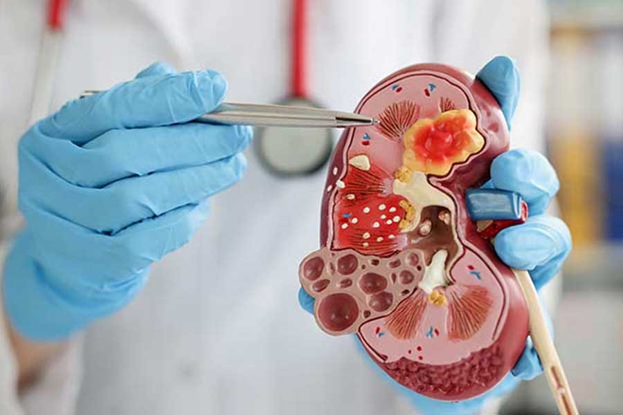 First Person to receive Pig kidney transplant dies after two month