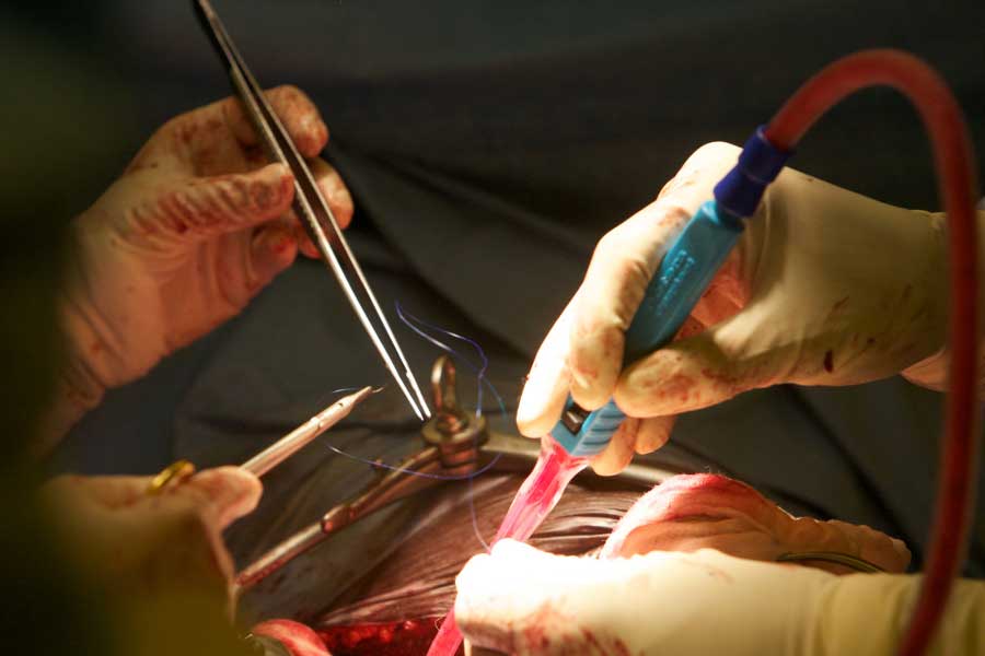 First Person to receive Pig kidney transplant dies after two month