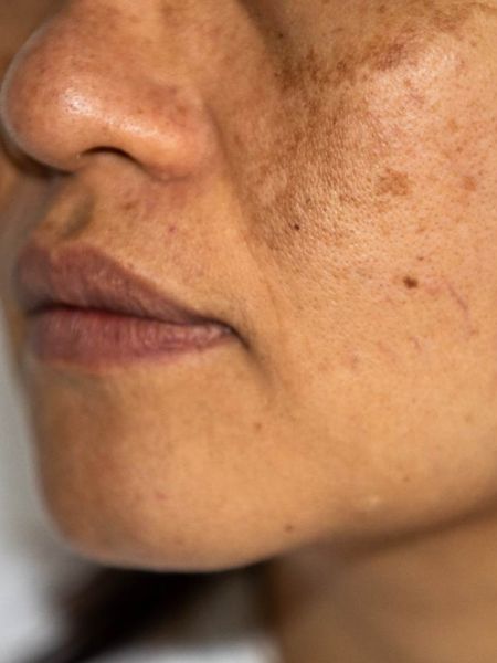 How to get rid of Skin Hyperpigmentation Naturally dgtl
