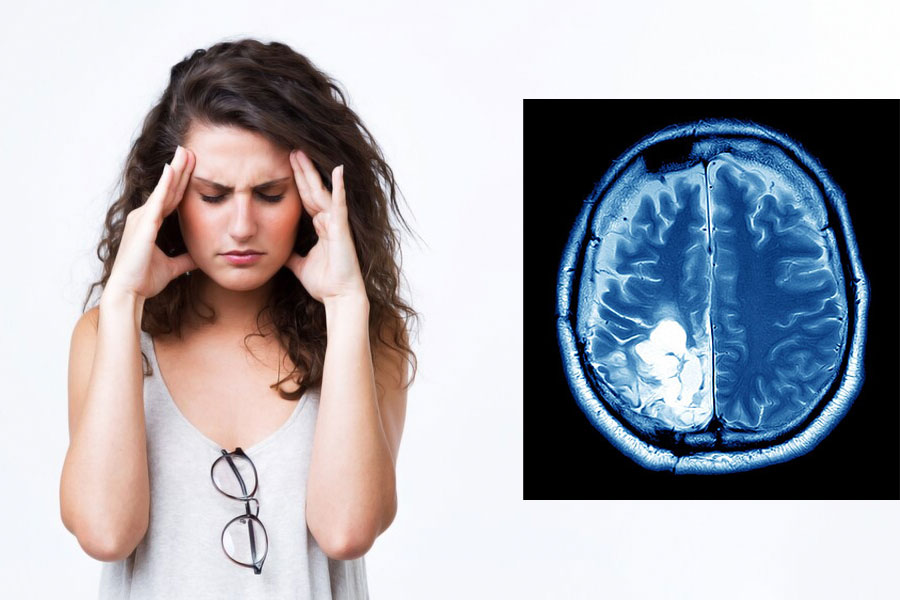 Can Mental Stress cause Brain Tumour