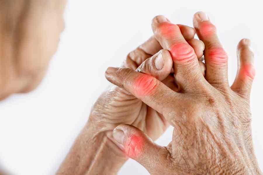 Foods you should avoid if you have Arthritis problem