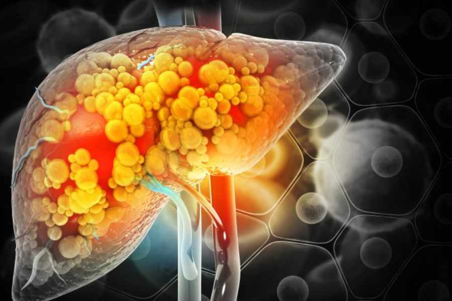 Liver disease causes and remedies