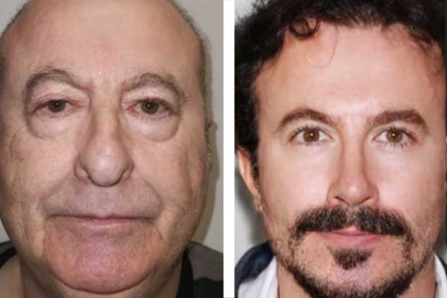Turkish people are turning 30 Years younger with jaw-dropping surgery