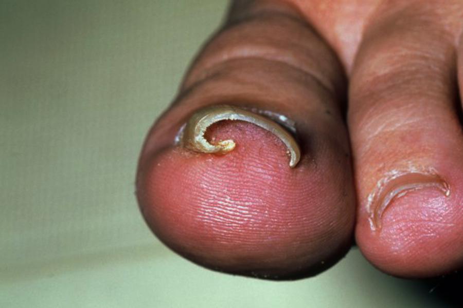Ingrown nails 