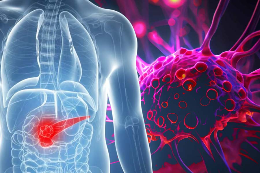 Pancreatic cancer cases have risen significantly in recent years