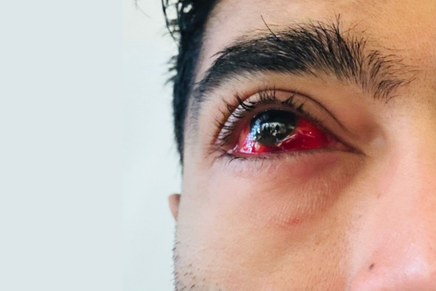 অস্ত্রোপচারের পর এখন অভিষেকের ডান চোখের যা পরিস্থিতি।