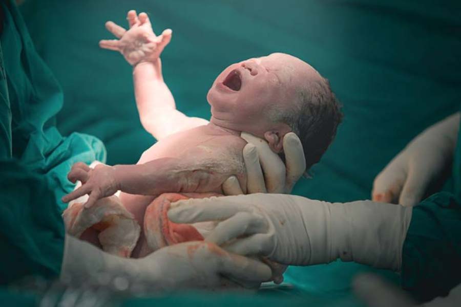 A four day old baby recovered from complicated intestinal problems