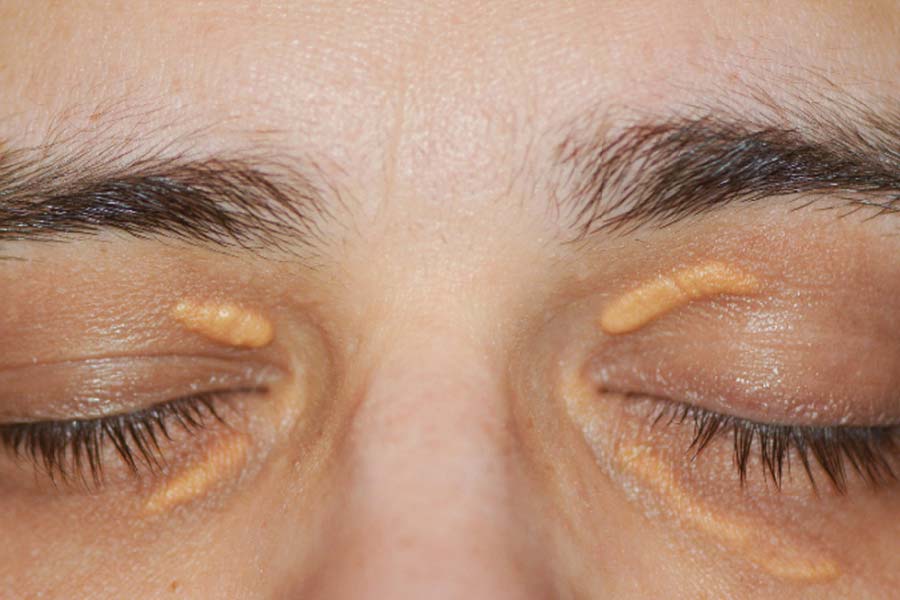 What is Xanthelasma, are eyelid bumps dangerous