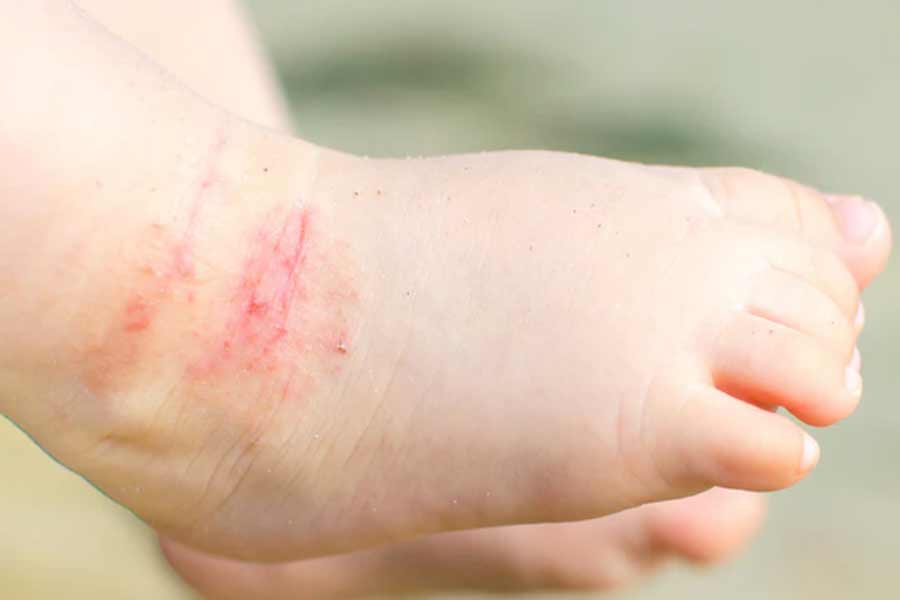 How to Treat & Control Eczema Rashes in Children