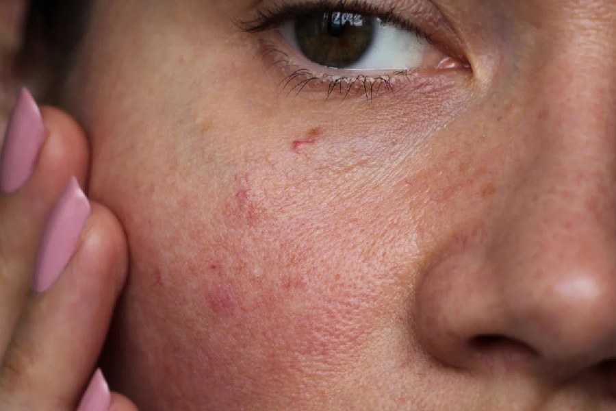 Try these natural remedies if you have sensitive skin