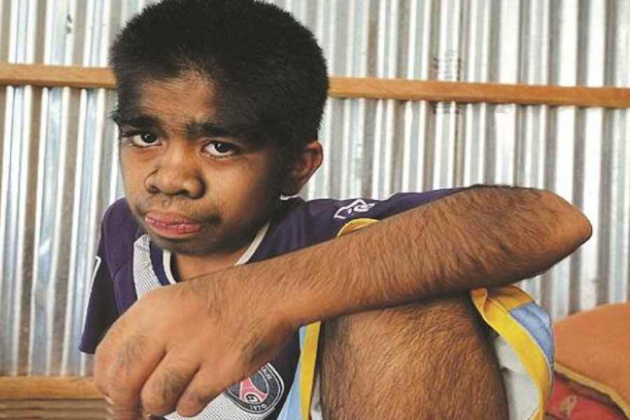 A teenage boy with a rare medical condition called Werewolf Syndrome 