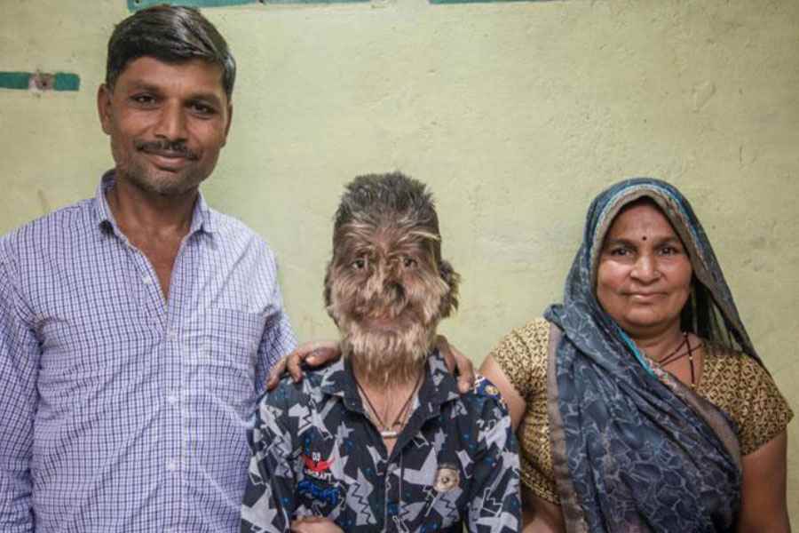 A teenage boy with a rare medical condition called Werewolf Syndrome 