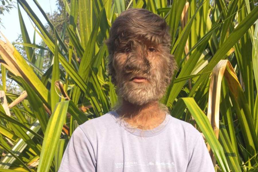 A teenage boy with a rare medical condition called Werewolf Syndrome 