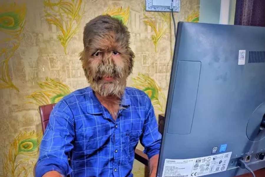 A teenage boy with a rare medical condition called Werewolf Syndrome 