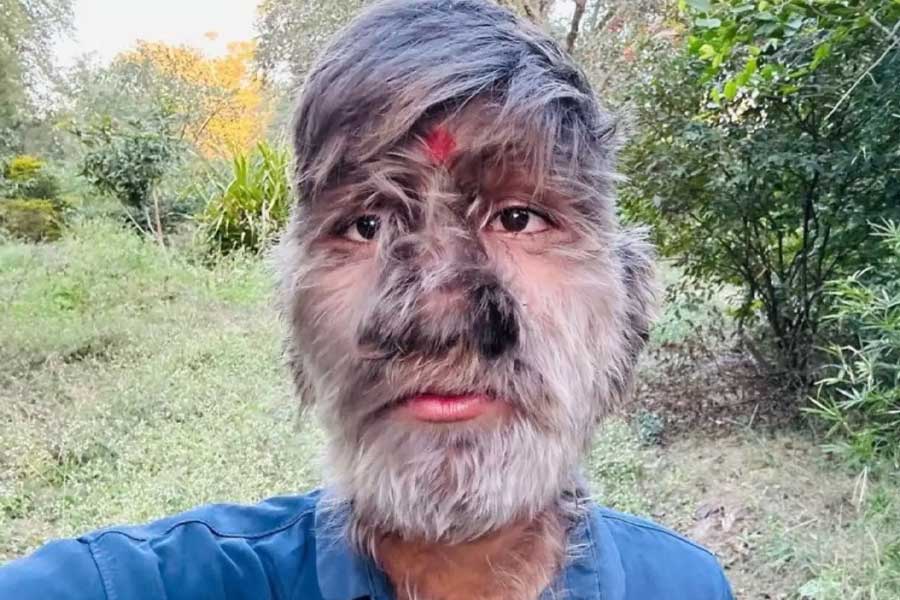 A teenage boy with a rare medical condition called Werewolf Syndrome 