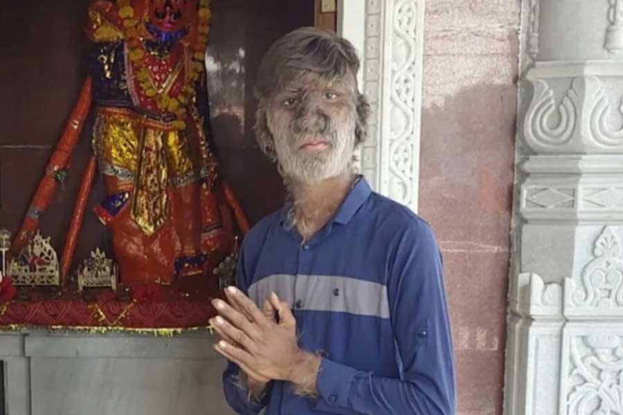 A teenage boy with a rare medical condition called Werewolf Syndrome 