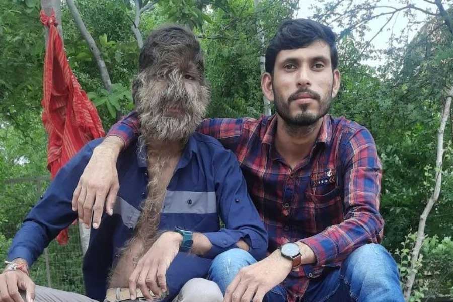 A teenage boy with a rare medical condition called Werewolf Syndrome 